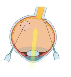 视网膜常见注射方法